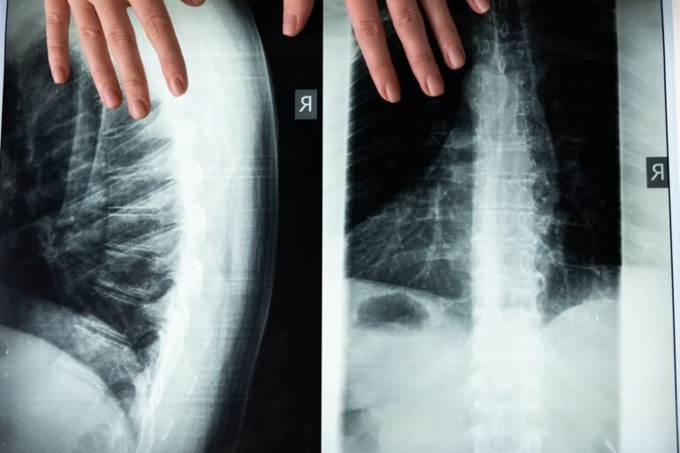 Mãe enfrenta governo e consegue cirurgia de escoliose para filha em RO